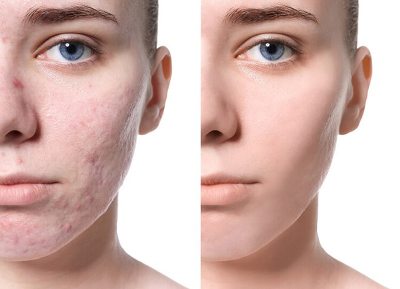 Top 20+ Thuốc Trị Sẹo Xeragel Giá Bao Nhiêu Bôi kem trị sẹo trước hay sau serum để phát HIỆU QUẢ quả tối đa 44 Kiên trì thực hiện để có được làn da sạch sẽ không còn sẹo