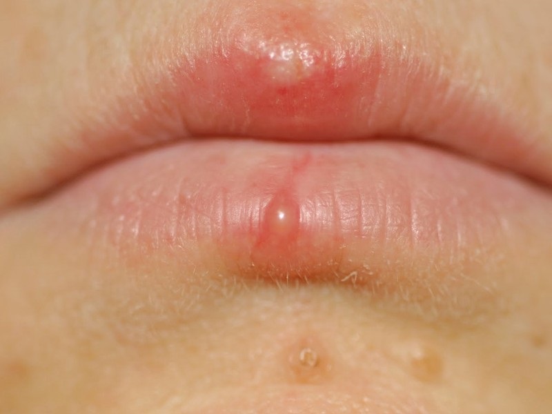 Top 20+ Thuốc Bôi Acyclovir Stada Cream Có Tác Dụng Gì Acyclovir bôi môi có tác dụng gì? Cách bôi acyclovir sau phun môi 20 Bác sĩ thường chỉ định bôi acyclovir khi môi bị mụn nước