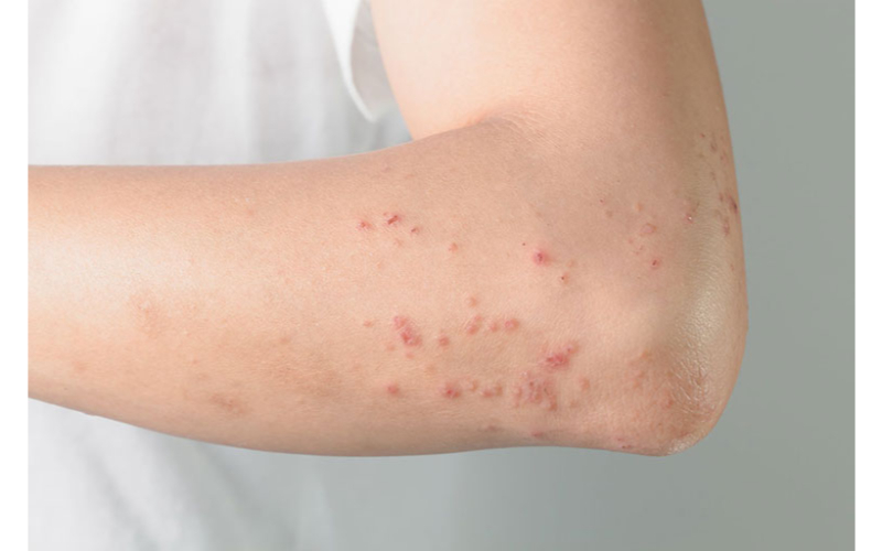 Lưu ý ngăn ngừa và điều trị nổi mụn ở tay không ngứa rất cần thiết