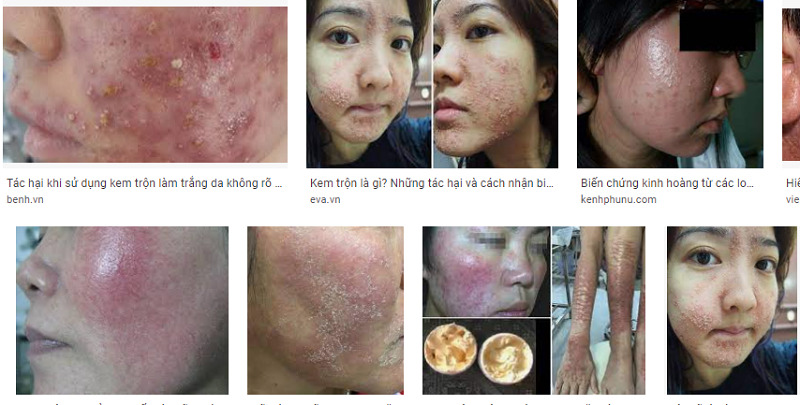 Top 20+ Kem Nghệ Herbal Thái Lan Có Phải Kem Trộn Không Tác hại của kem trộn chứa Corticoid– Sản phẩm hủy hoại làn da 26 Rất nhiều hình ảnh, biến chứng của việc sử dụng kem trộn trên các trang tìm kiếm