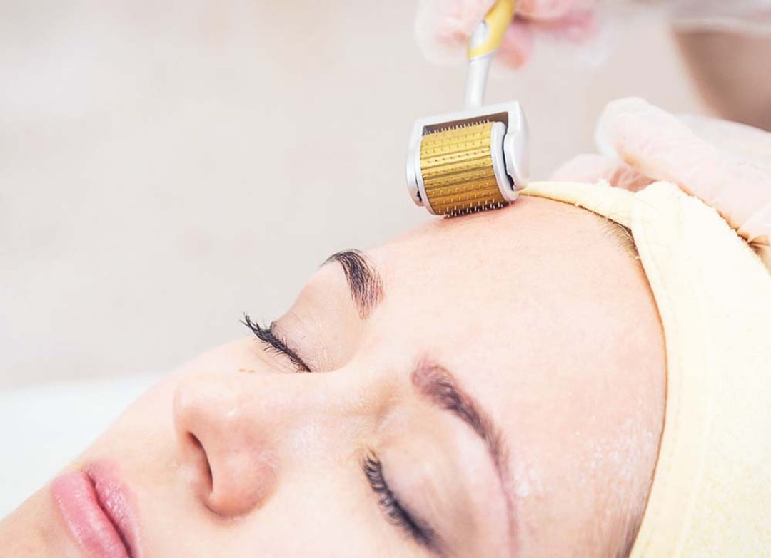 Trị sẹo mụn bằng phương pháp lăn kim