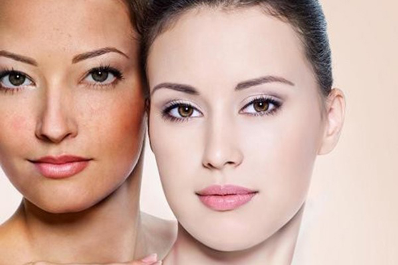 Các vấn đề cần chú ý khi trị nám bằng hoạt chất