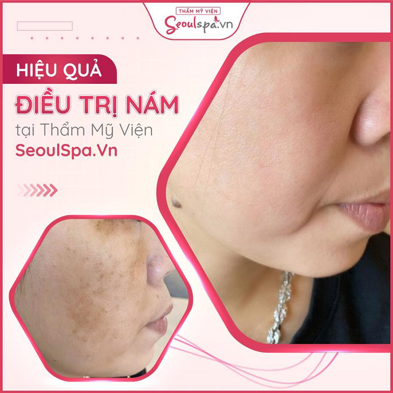 Loại bỏ nám da nhanh chóng và mang đến hiệu quả vô cùng cao