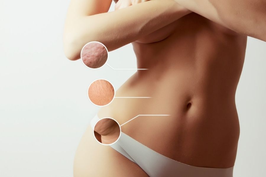Hút mỡ bụng rất an toàn, ít xâm lấn và không để lại sẹo trên da