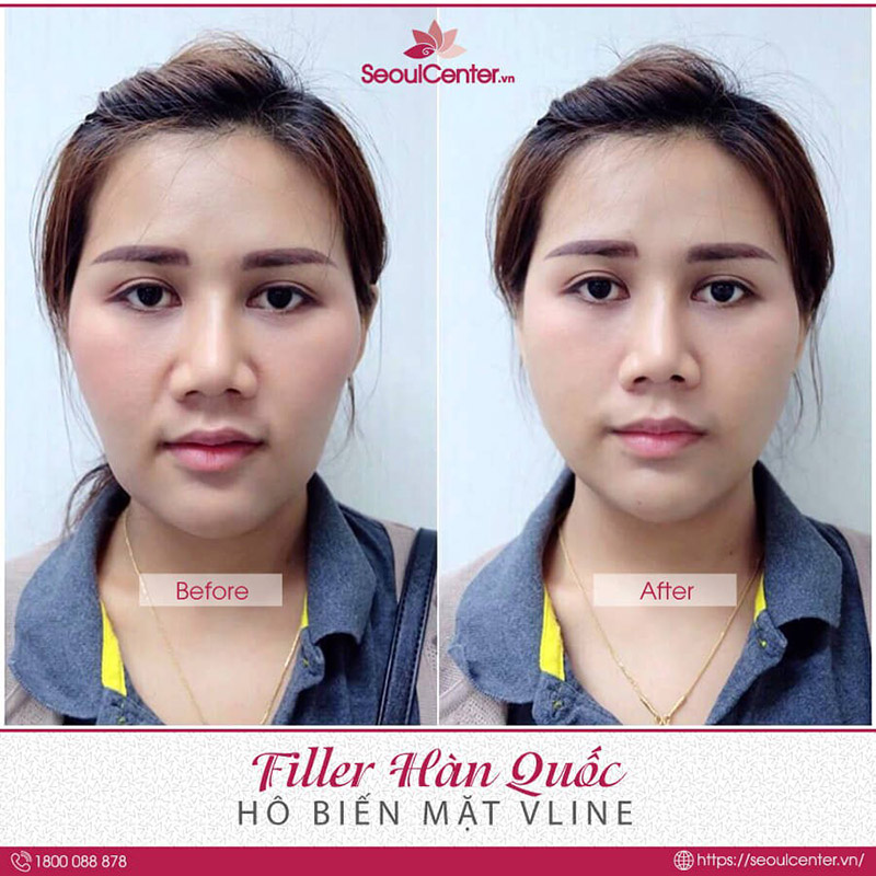 Mang đến hiệu quả khuôn mặt V- line hoàn hảo khi tiêm filler tại Seoul Spa