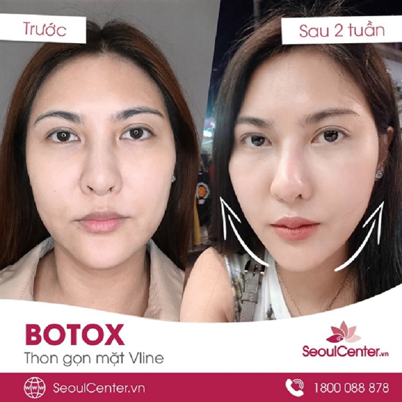 Hiệu quả tiêm botox gọn mặt của khách hàng