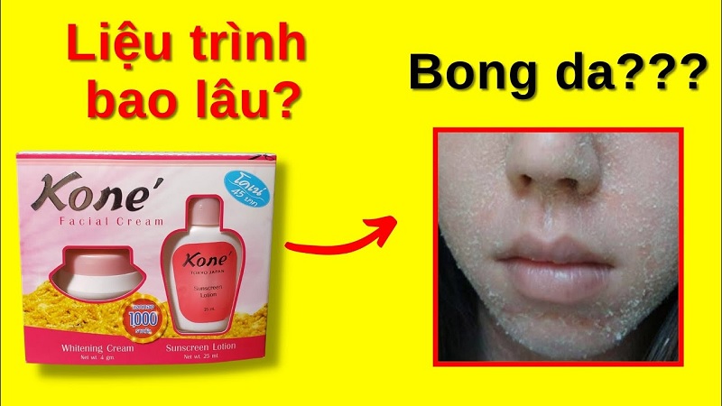 Thời gian đầu, kem Kone có thể gây bong da