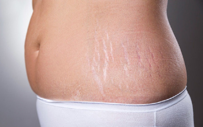 Rạn da khiến chị em đánh mất đi vẻ đẹp thẩm mỹ của làn da