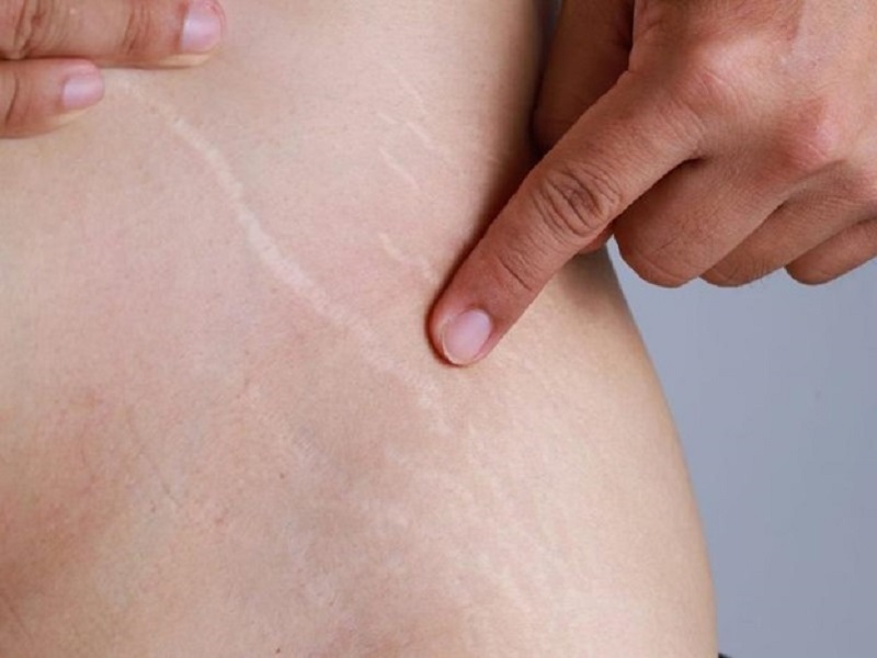 Vết rạn da thường bắt đầu xuất hiện khi cơ thể bước sang tuổi dậy thì