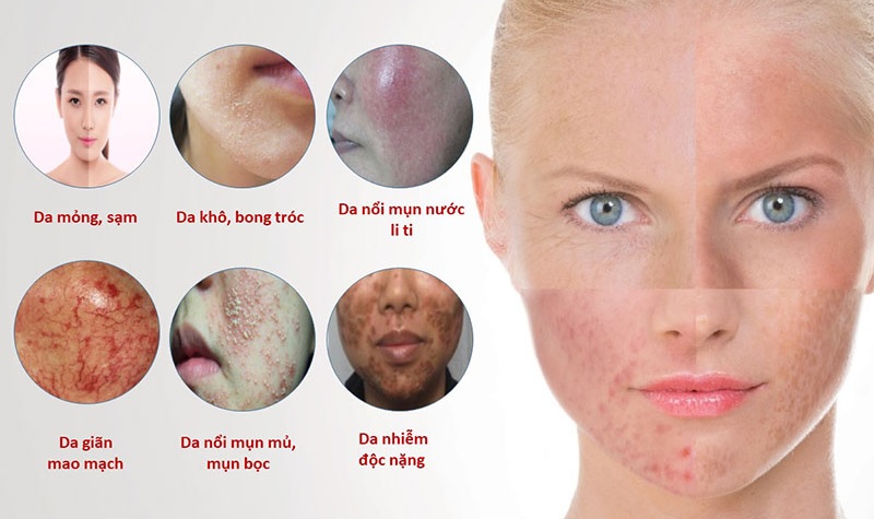 Dấu hiệu da nhiễm corticoid do sử dụng kem trộn