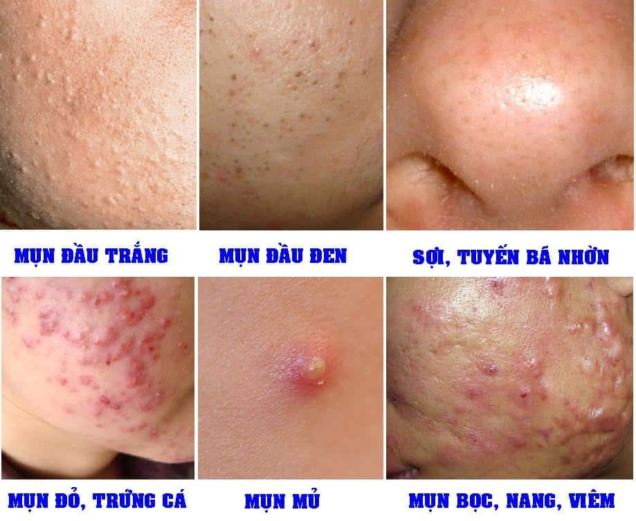 Các loại mụn thường nổi trên da