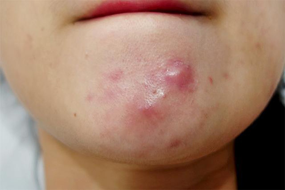 Những nốt mụn viêm, sưng đỏ thì không nên nặn