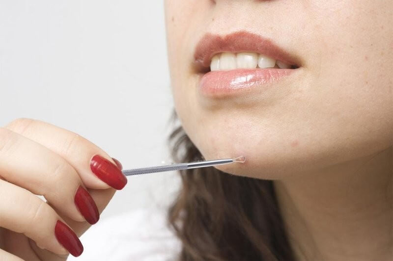 Cần phải làm sạch tay, sát trùng cây nặn mụn trước khi xử lý nhân mụn