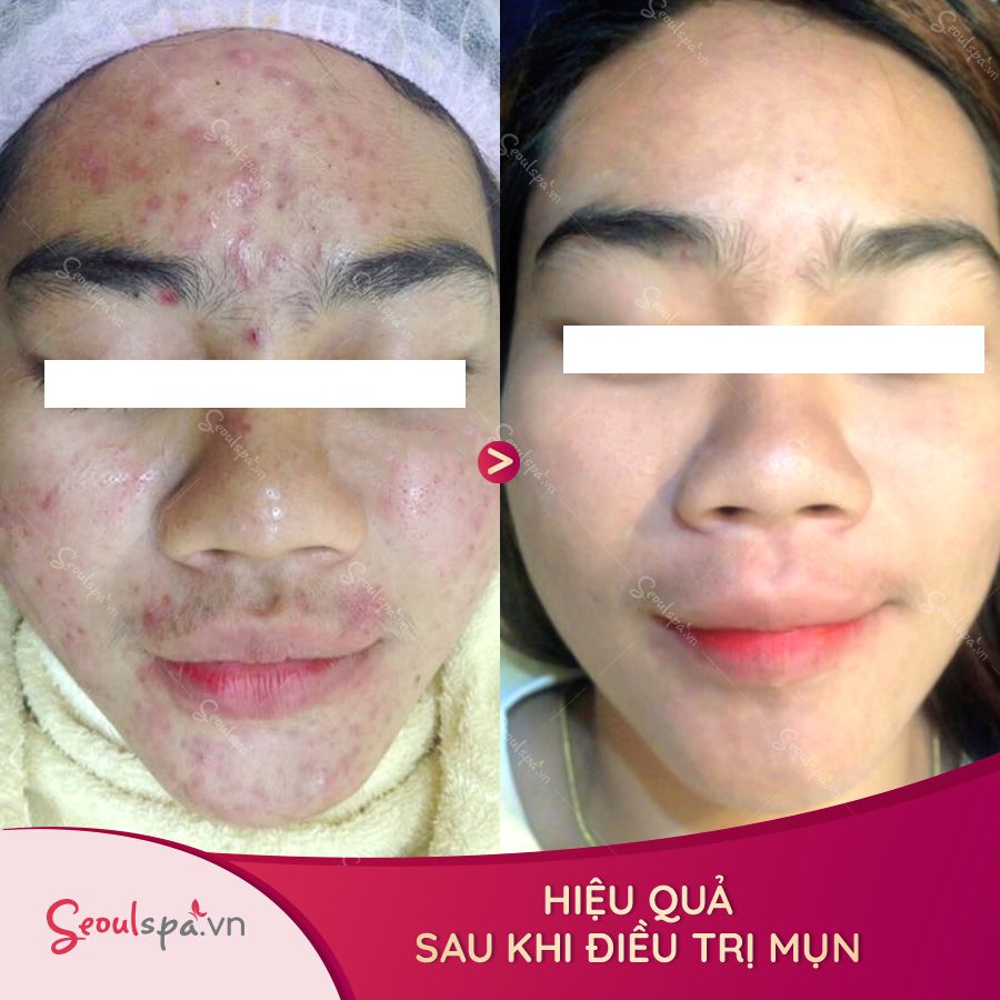 Kết quả điều trị mụn tại SeoulSpa.Vn
