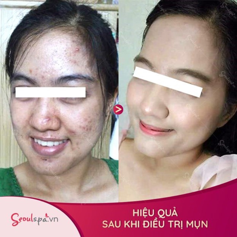 Lăn kim trị mụn bao lâu thì lành