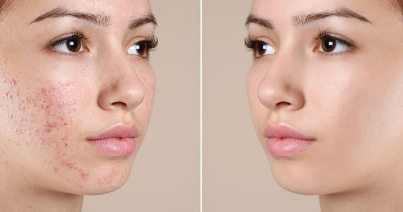 Top 20+ Cây Mã Đề Có Tác Dụng Chữa Bệnh Gì Cây mã đề trị mụn có tốt không? Những lưu ý khi sử dụng loại cây này? 18 Chuối hột có khả năng trị mụn hiệu quả
