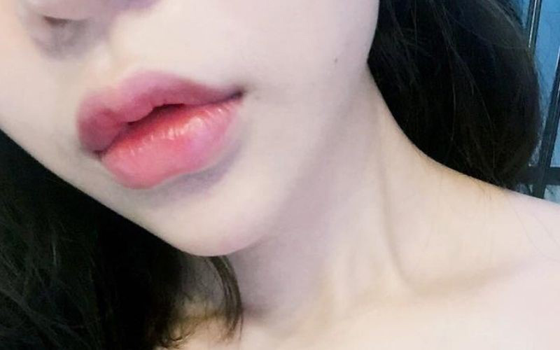 Top 20+ Tiêm Filler Môi Bao Lâu Thì Hết Sưng Tiêm filler xong bị sưng là do đâu? Cách khắc phục tình trạng này 41 Tiêm filler xong bị sưng tầm 3 - 5 ngày là hết