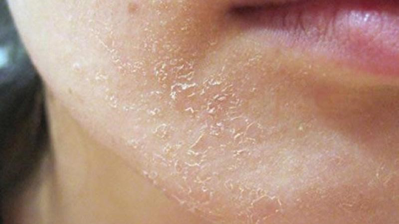 Khiến da bị khô, dễ bong tróc