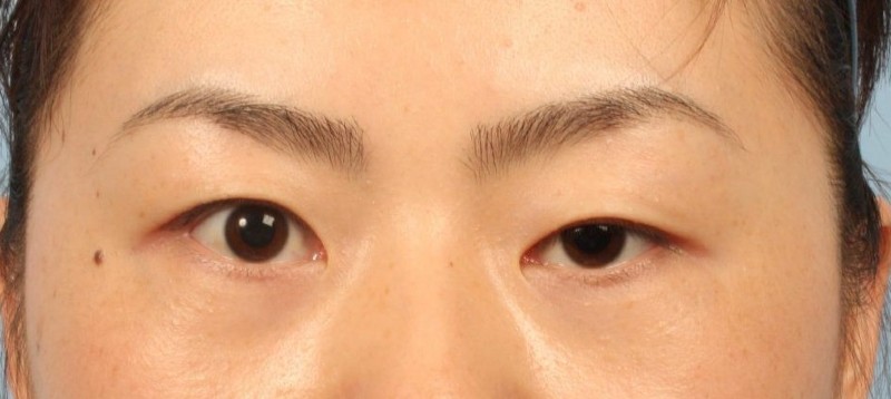 Mắt to mắt nhỏ là tình trạng chung của nhiều chị em hiện nay