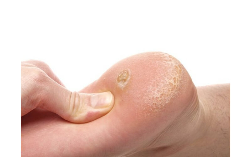 Cần lưu ý vị trí phát bệnh để điều trị phù hợp