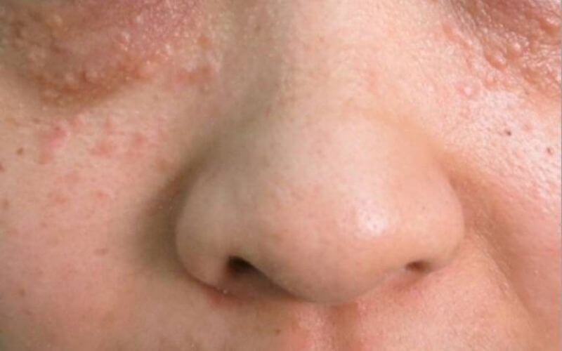 Cần nắm một số lưu ý để ngăn ngừa lây nhiễm mụn cơm