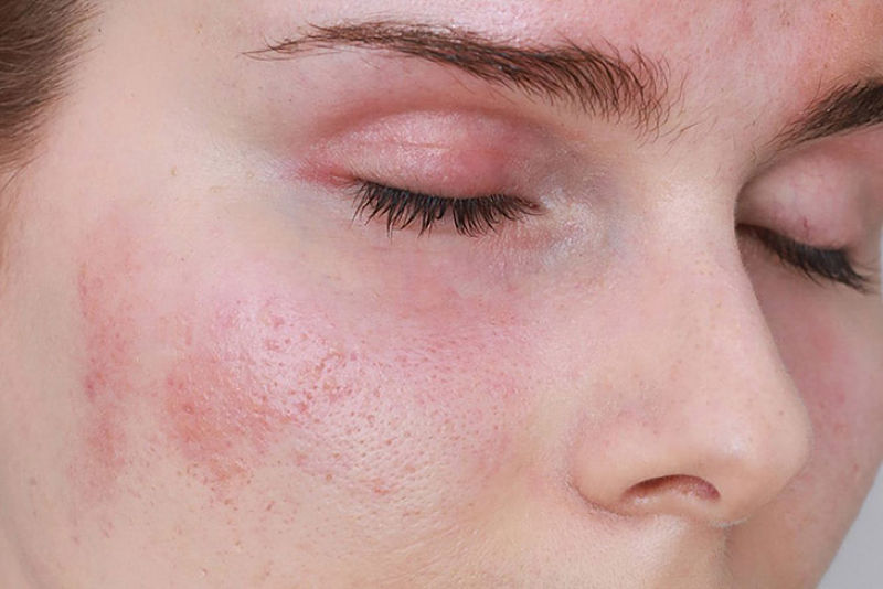 Lạm dụng vitamin E có thể khiến làn da bị nổi mụn