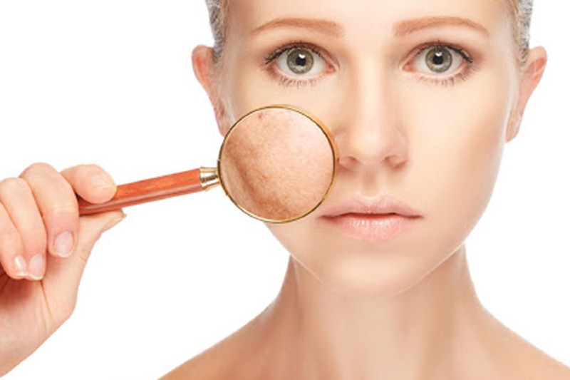 Biểu hiện của nám thông thường