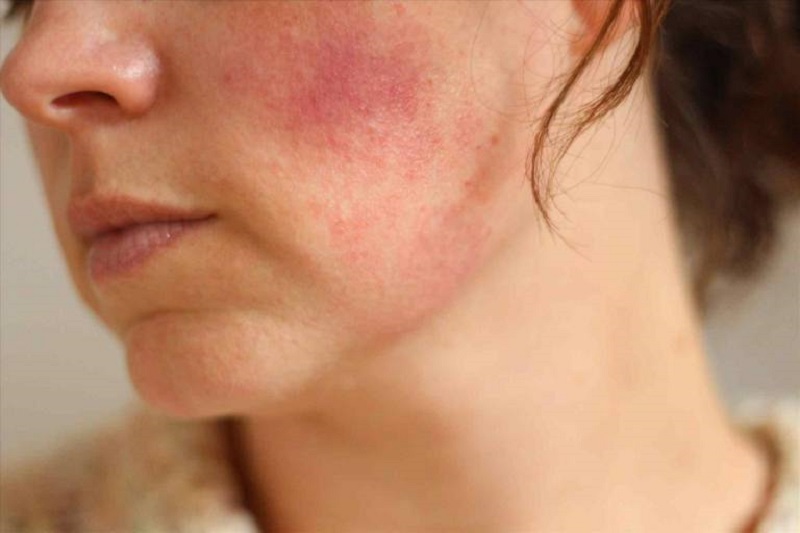 Top 20+ Kem Nghệ Herbal Thái Lan Có Phải Kem Trộn Không Tác hại của kem trộn chứa Corticoid– Sản phẩm hủy hoại làn da 31 Da ửng đỏ ở hai bên má, có cảm giác ngứa, nóng khắp mặt ở giai đoạn nhận biết kem trộn muộn