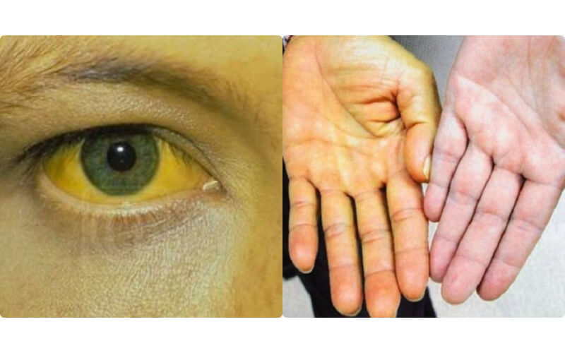Làn da chuyển vàng là dấu hiệu nóng trong trầm trọng