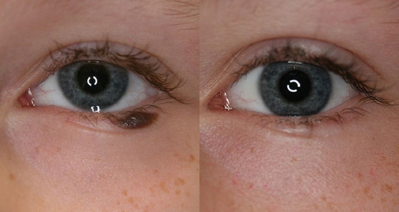 Công nghệ Laser CO2 Fractional loại bỏ nốt ruồi không mong muốn vĩnh viễn