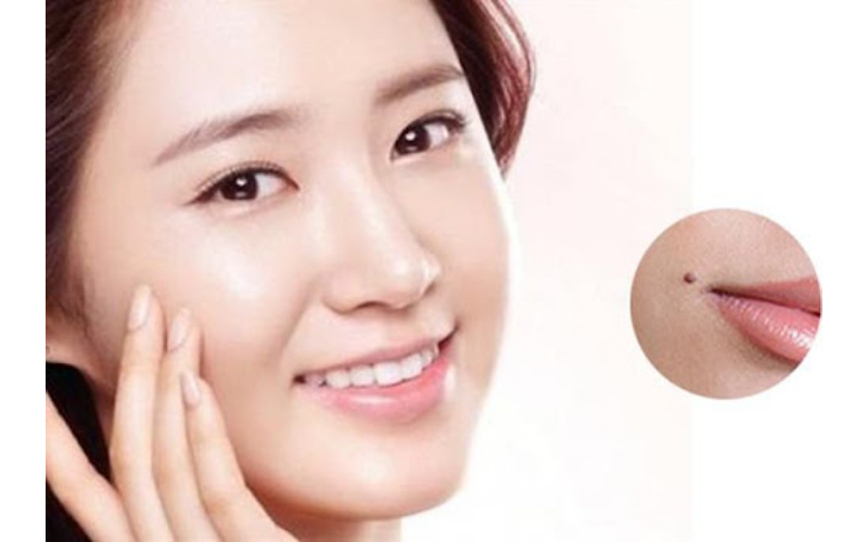 Nốt ruồi trên môi gây mất thẩm mỹ và có thể là biểu hiện của bệnh ung thư da
