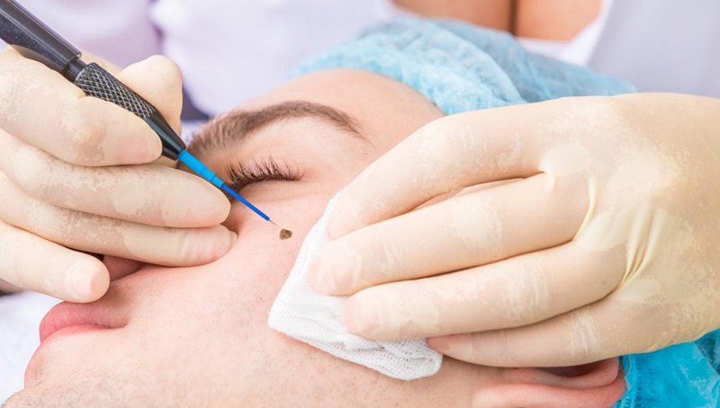 Phụ nữ có thể tẩy nốt ruồi để đảm bảo tính thẩm mỹ