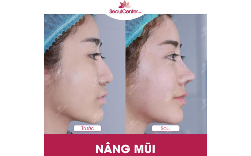 Top 20+ Nâng Mũi Bán Cấu Trúc Giá Bao Nhiêu Nâng mũi bán cấu trúc là gì? Có nên nâng mũi bán cấu trúc không? 24 Seoul Central International Beauty Clinic là bệnh viện nâng mũi bán cấu trúc uy tín hàng đầu hiện nay