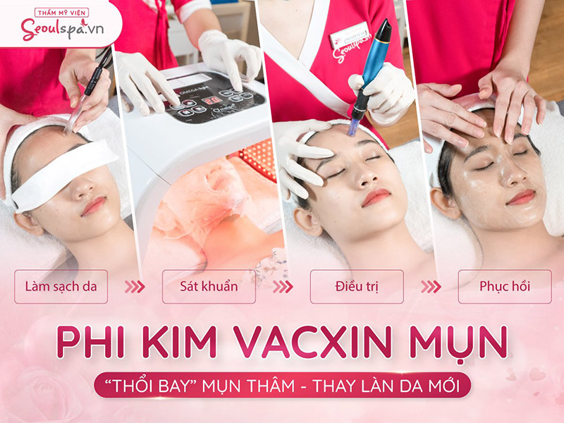 Phim kim Vacxin trị mụnPhim kim Vacxin trị mụn