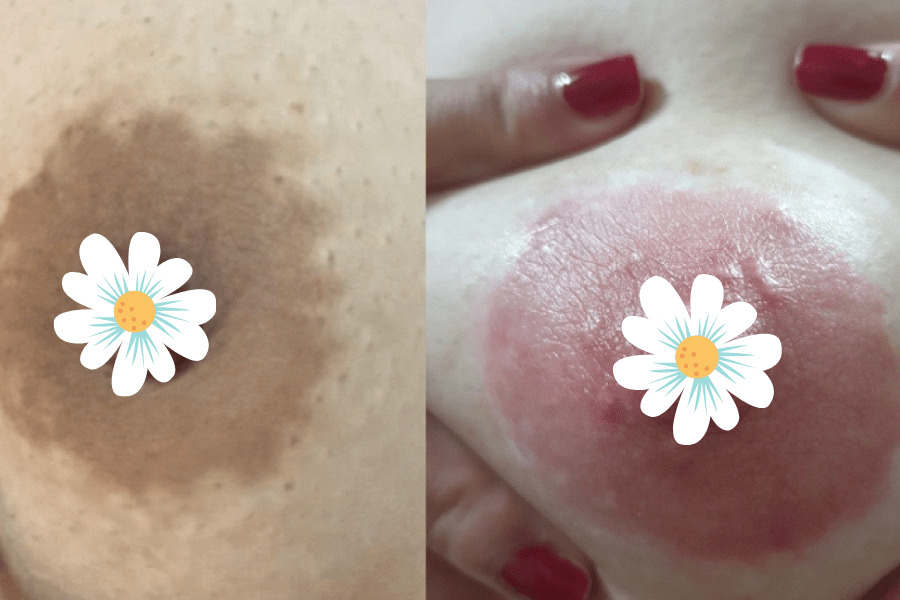 Hiệu quả peel làm hồng nhũ hoa của khách hàng tại Thẩm mỹ viện Seoul Spa