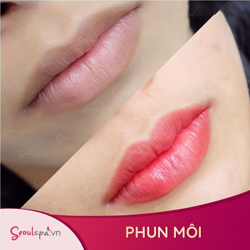 Công nghệ Laser CO2 Fractional hiện đại