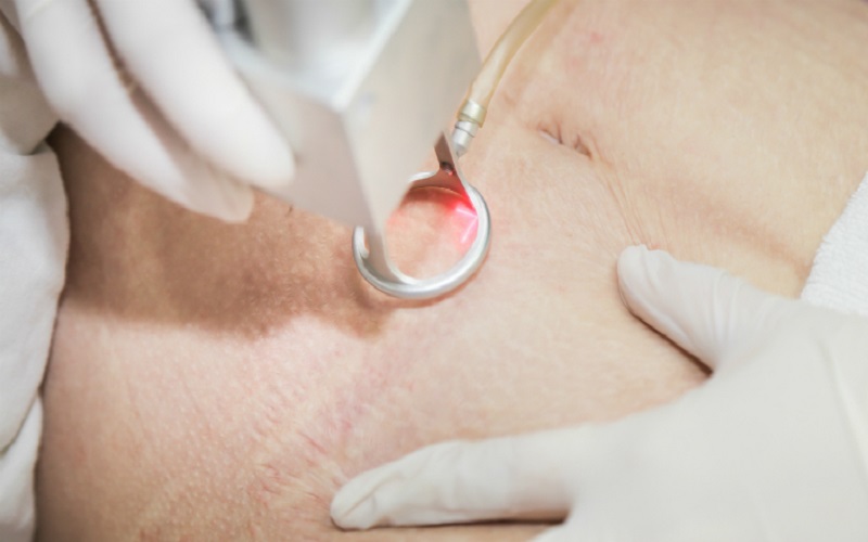 Top 20+ Trị Rạn Da Bằng Laser Bao Nhiêu Tiền Trị rạn da bằng laser bao nhiêu tiền? Có hiệu quả không? 22 Điều trị rạn da bằng laser nhanh chóng và an toàn