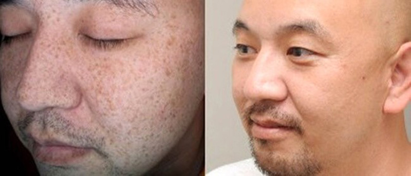 Bổ sung thêm dưỡng chất và sống lành mạnh để giúp tăng hiệu quả trị nám