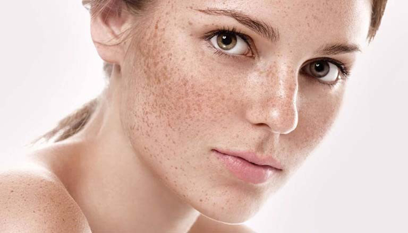 Công dụng của serum trị nám hiệu quả