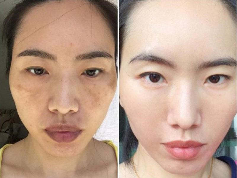 serum trị nám tốt nhất hiện nay