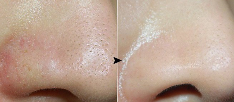 Giúp trị mụn đầu đen hiệu quả