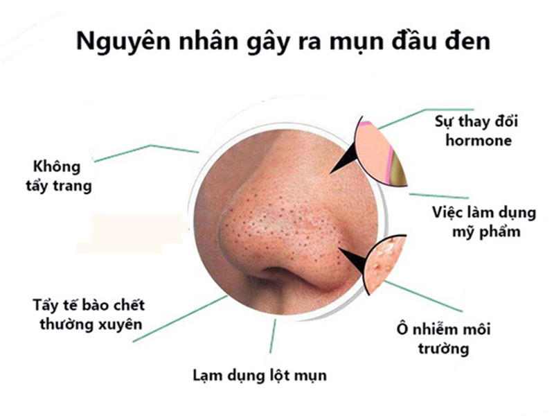 Nguyên nhân gây mụn đầu đen