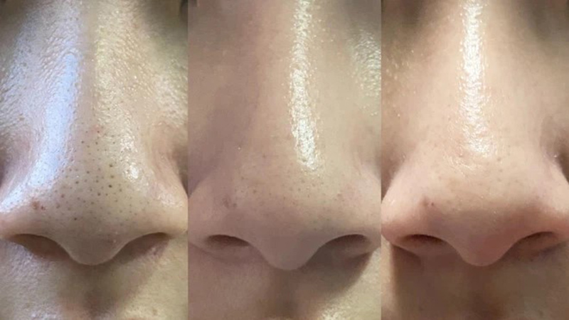 Tẩy tế bào chết