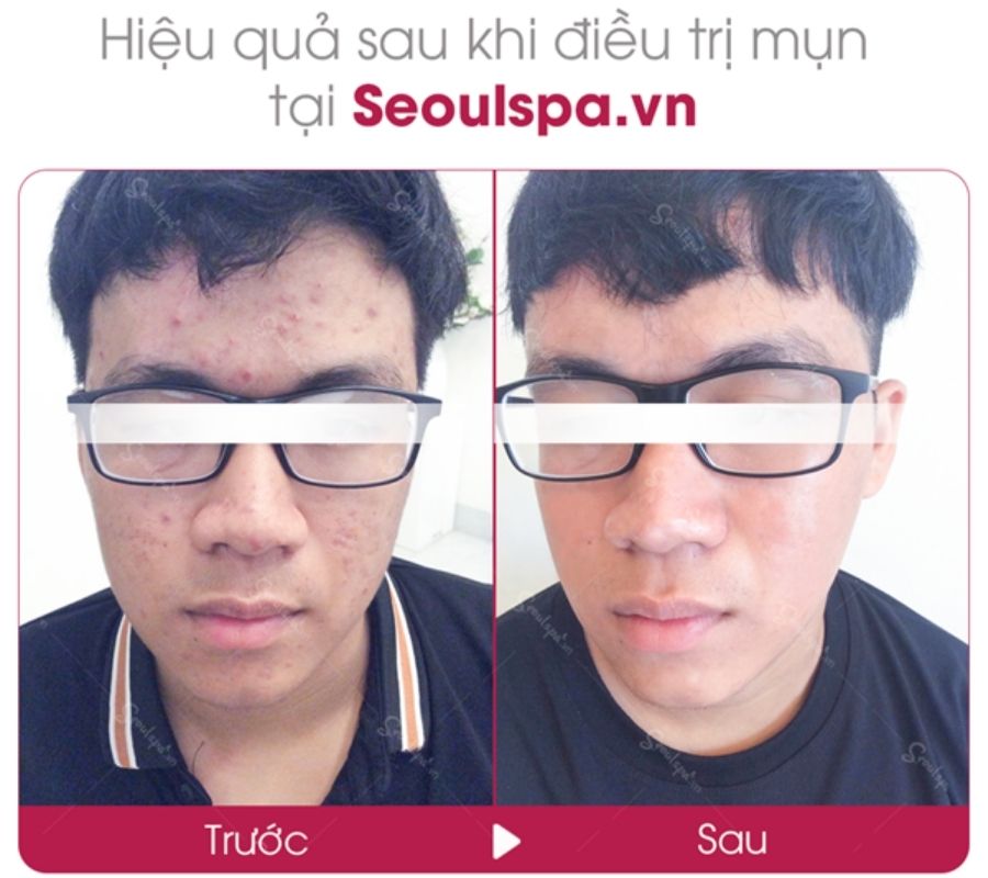 Điều trị sạch mụn tận gốc mang lại vẻ đẹp lịch lãm