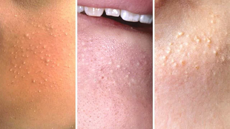 Top 20+ Cách Trị Mụn Đầu Trắng Ẩn Dưới Da Cách trị mụn đầu trắng ẩn dưới da siêu hiệu quả bằng tự nhiên 50 Mụn đầu trắng có tự hết?