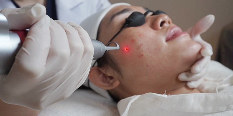 Nên áp dụng công nghệ Laser tẩy nốt ruồi để mang lại hiệu quả nhanh chóng và an toàn hơn