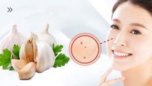 Top 10 cách tẩy nốt ruồi tại nhà hiệu quả mà dễ thực hiện 3 Các thành phần trong tỏi có thể loại bỏ tẩy nốt ruồi