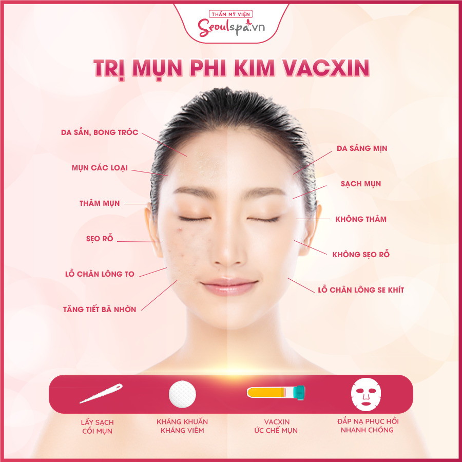 Công nghệ phi kim vaccin mụn mang lại nhiều lợi ích cho da