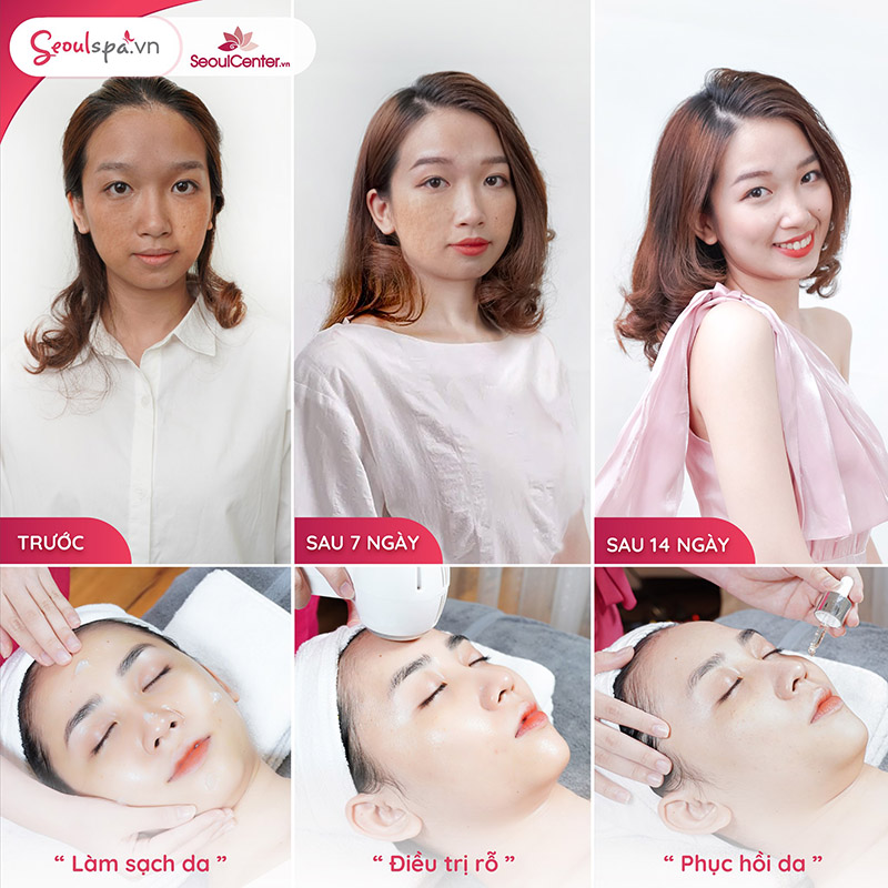 Phục hồi da sau khi trị sẹo rỗ
