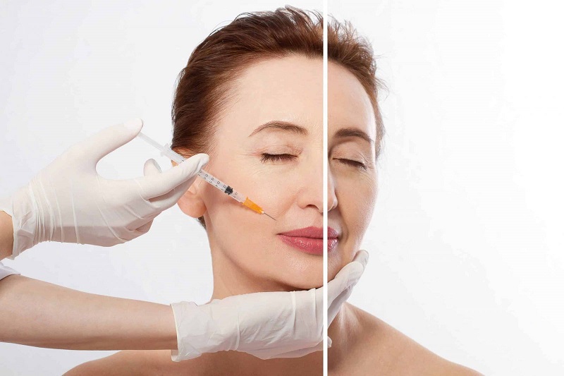 Nếu bạn muốn trẻ hóa da, xóa nếp nhăn thì nên tiêm Botox căng da mặt tại địa chỉ uy tín